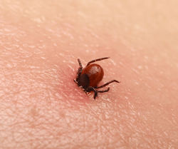 Tick Buried in Skin
